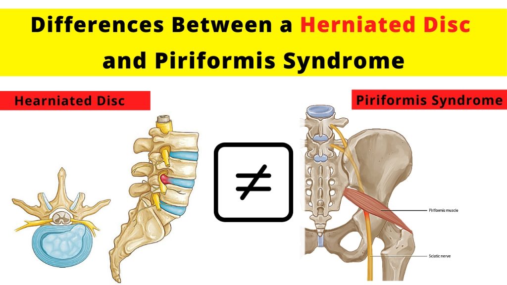 Piriformis syndrome or disc herniation, how do you tell the