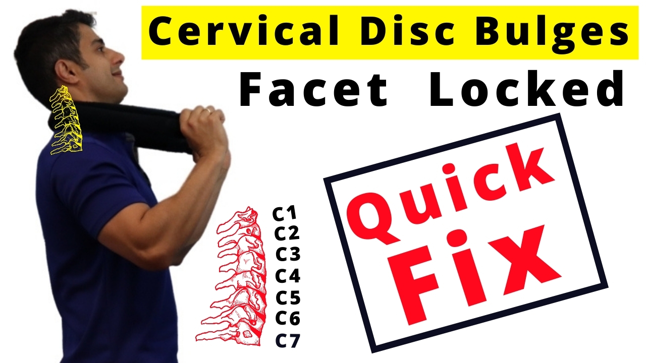 cervical-disc-bulge-and-cervical-facet-lock-pain-relief-dublin-sports