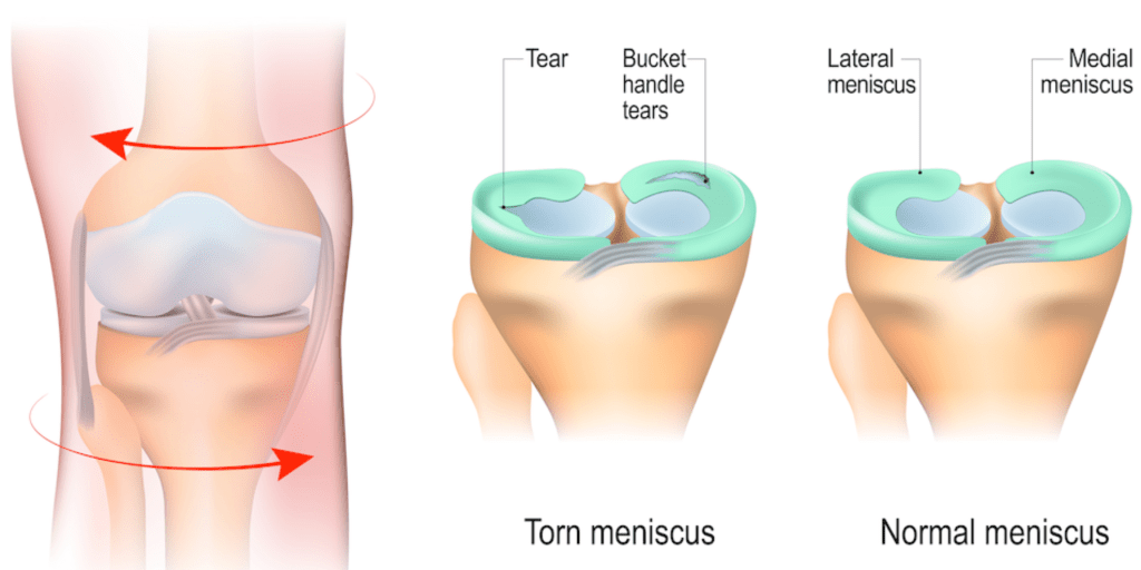 Meniscus Tear Management