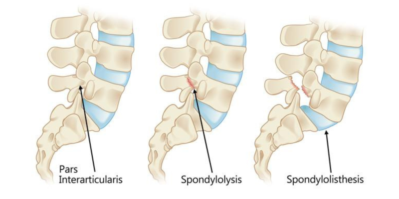 Spondylolysis and Spondylolisthesis rehabilitation exercises